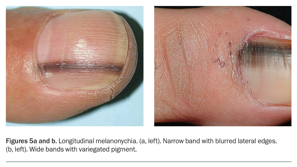 Evaluation and management of nail diseases Medicine Today